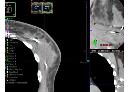 Accusyte in breast tissue