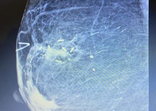 Accusyte in breast tissue