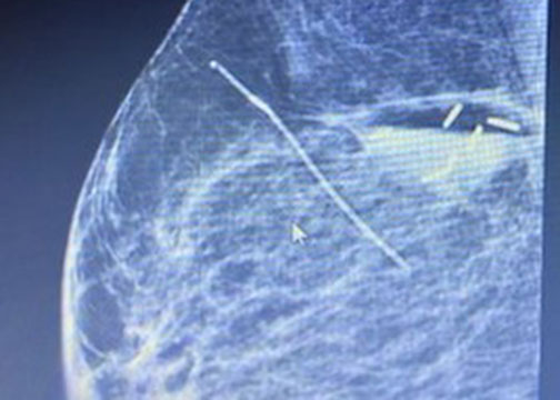 Accusyte in breast tissue