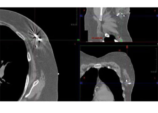 Accusyte in breast tissue