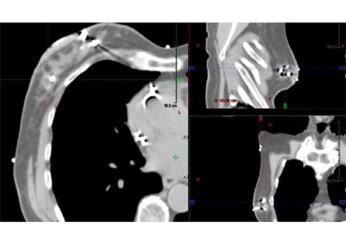 Accusyte in breast tissue